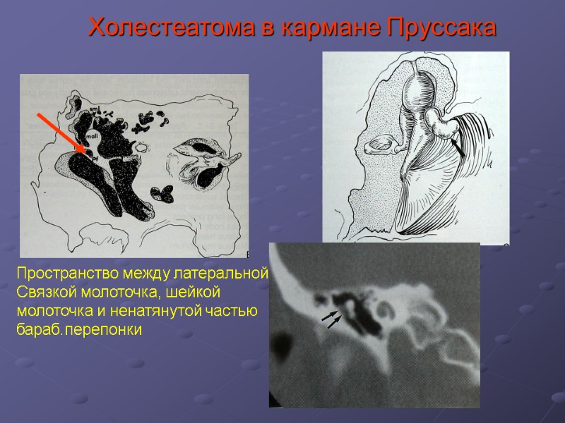 Холестеатома в кармане Пруссака Пространство между латеральной Связкой молоточка, шейкой  молоточка и ненатянутой